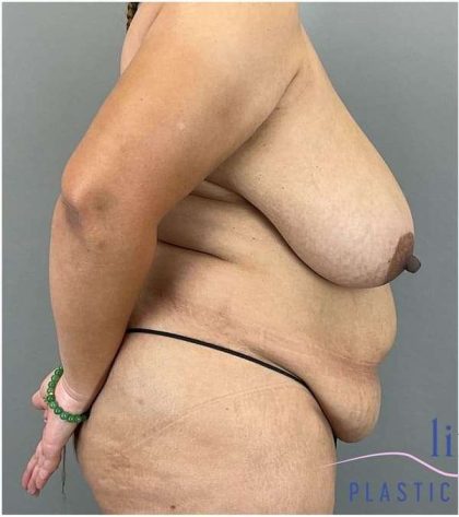 Breast Reduction Before & After Patient #664