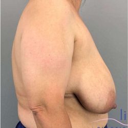 Breast Reduction Before & After Patient #675