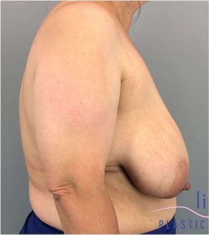 Breast Reduction Before & After Patient #675