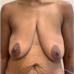 Breast Reduction Before & After Patient #686