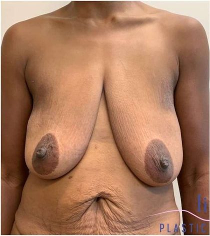 Breast Reduction Before & After Patient #686