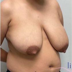 Breast Reduction Before & After Patient #697