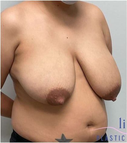 Breast Reduction Before & After Patient #697