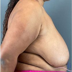 Breast Reduction Before & After Patient #708