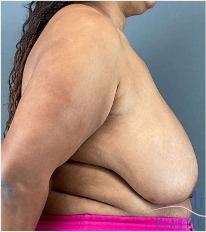 Breast Reduction Before & After Patient #708