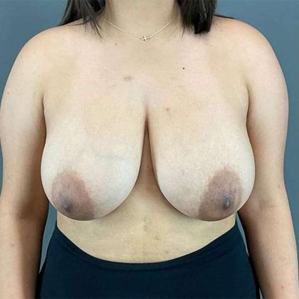 Breast Reduction Before & After Patient #719