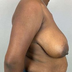 Breast Reduction Before & After Patient #730