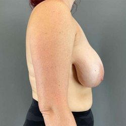 Breast Reduction Before & After Patient #741