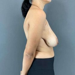 Breast Reduction Before & After Patient #752