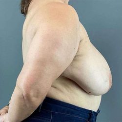 Breast Reduction Before & After Patient #763