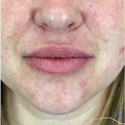 Injectables&Fillers Before & After Patient #155