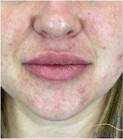 Injectables&Fillers Before & After Patient #155