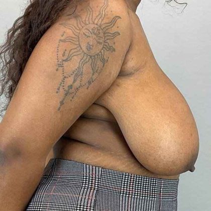 Breast Reduction Before & After Patient #774