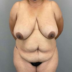 Breast Reduction Before & After Patient #785