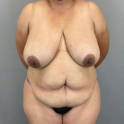 Breast Reduction Before & After Patient #785