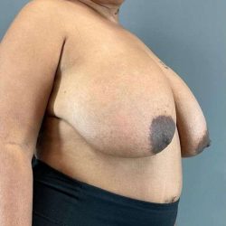 Breast Reduction Before & After Patient #792