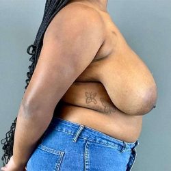 Breast Reduction Before & After Patient #810