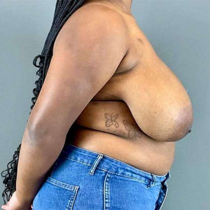 Breast Reduction Before & After Patient #810