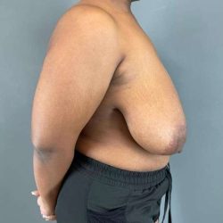 Breast Reduction Before & After Patient #828