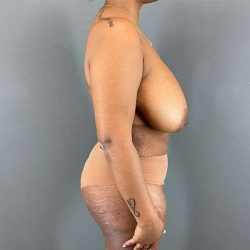 Breast Reduction Before & After Patient #839