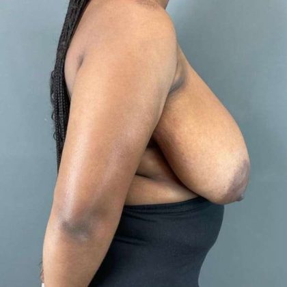 Breast Reduction Before & After Patient #861