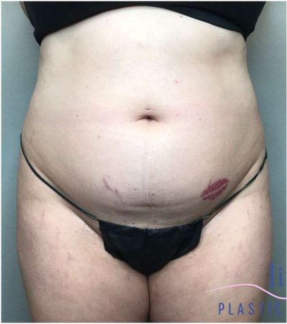 Liposuction Before & After Patient #166