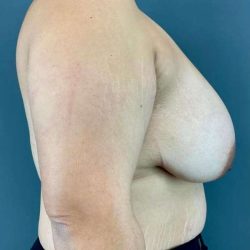 Breast Reduction Before & After Patient #872