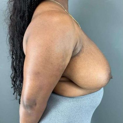 Breast Reduction Before & After Patient #883