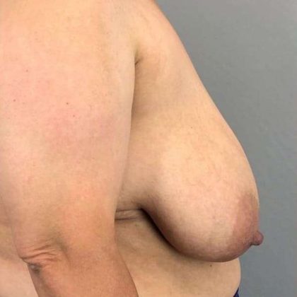 Breast Reduction Before & After Patient #894
