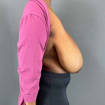 Breast Reduction Before & After Patient #905