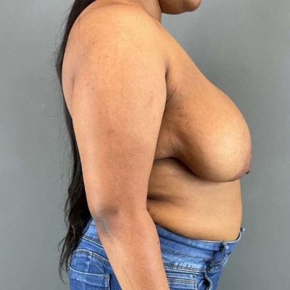 Breast Reduction Before & After Patient #916