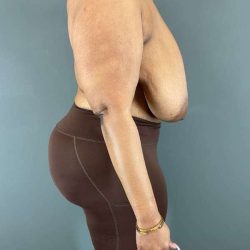Breast Reduction Before & After Patient #927