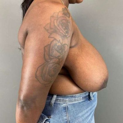Breast Reduction Before & After Patient #938