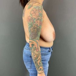 Breast Reduction Before & After Patient #949