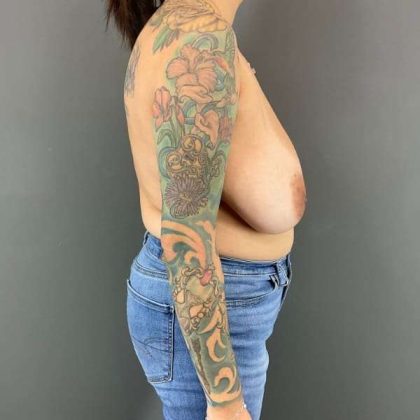 Breast Reduction Before & After Patient #949