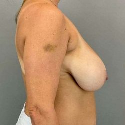Breast Reduction Before & After Patient #956