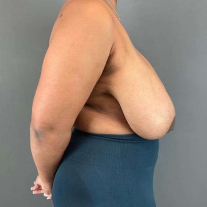Breast Reduction Before & After Patient #967