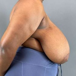 Breast Reduction Before & After Patient #978