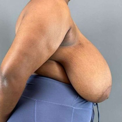 Breast Reduction Before & After Patient #978
