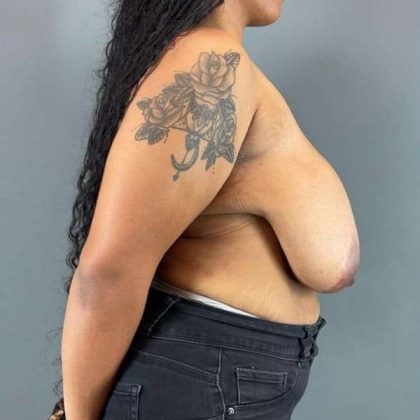 Breast Reduction Before & After Patient #998