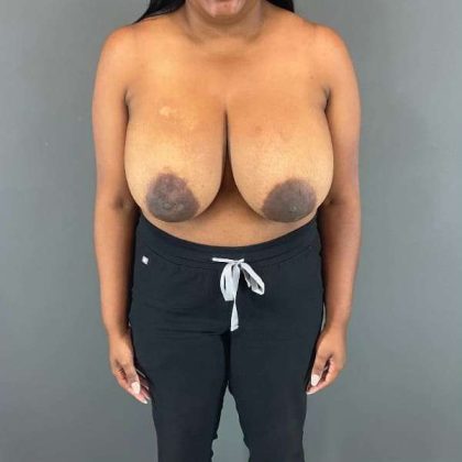 Breast Reduction Before & After Patient #1007