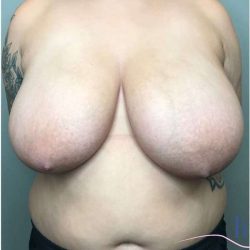 Breast Reduction Before & After Patient #1029