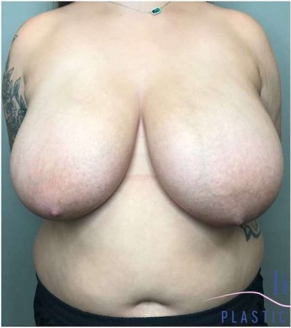 Breast Reduction Before & After Patient #1029