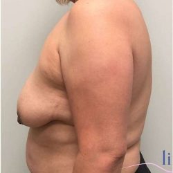 Breast Lift Before & After Patient #1040