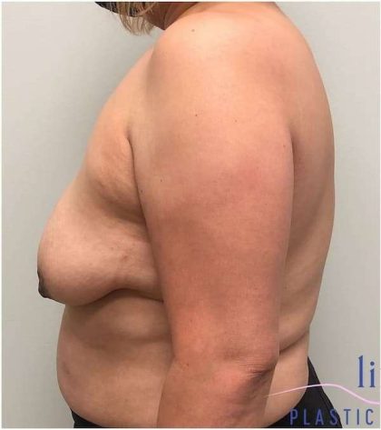 Breast Lift Before & After Patient #1040