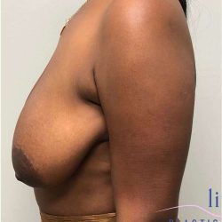 Breast Lift Before & After Patient #1051