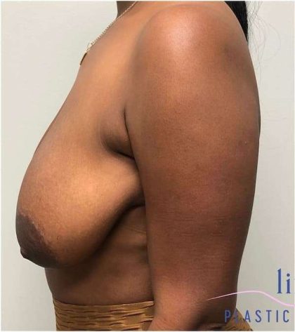 Breast Lift Before & After Patient #1051