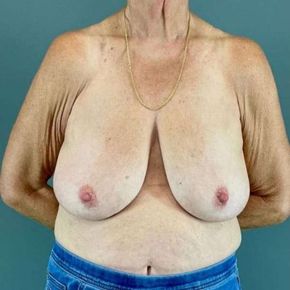 Breast Lift Before & After Patient #1062