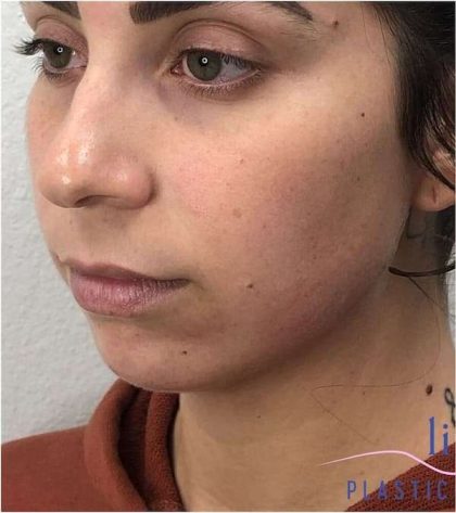 Injectables&Fillers Before & After Patient #125