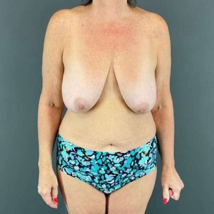 Breast Lift Before & After Patient #1091